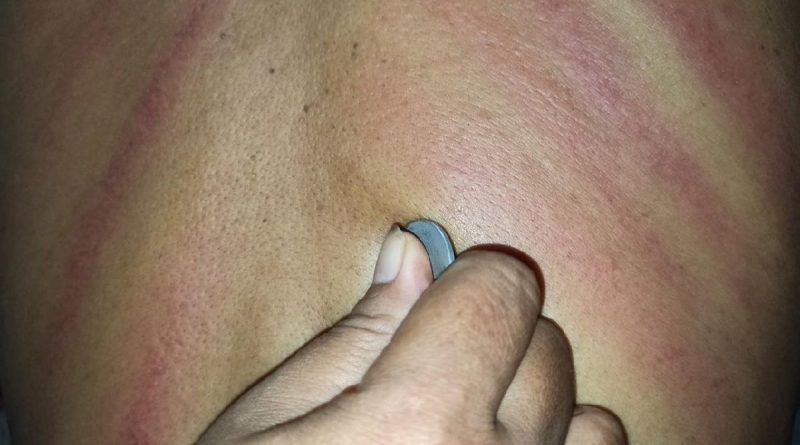4 RISIKO KEROKAN BAGI KESEHATAN PERLU DIKETAHUI